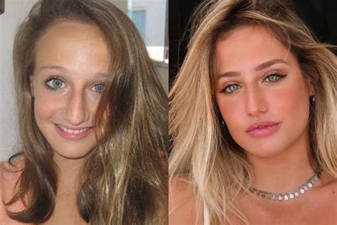 bruna griphao antes da cirurgia|Antes e depois: especialistas explicam mudança。